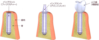 フィクスチャ―